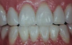 Cosmetic Dental Veneers After