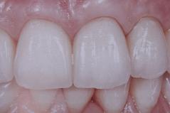 Cosmetic Dental Crowns After