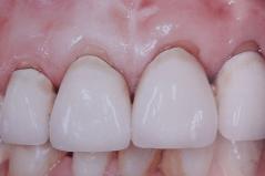 Cosmetic Dental Crowns Before