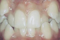 Cosmetic Dental Orthodontic Before