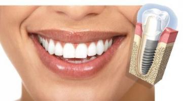 implantes dentales ortodoncia estetica odontopediatria 5455 MLA439732720 438 O4