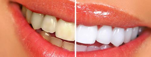Zoom Tooth whitening